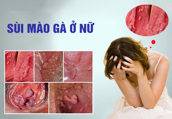 chữa sùi mào gà