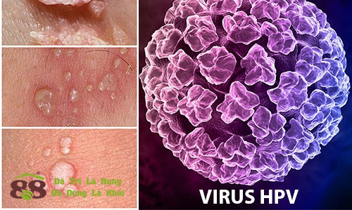 đào thải viruts hpv