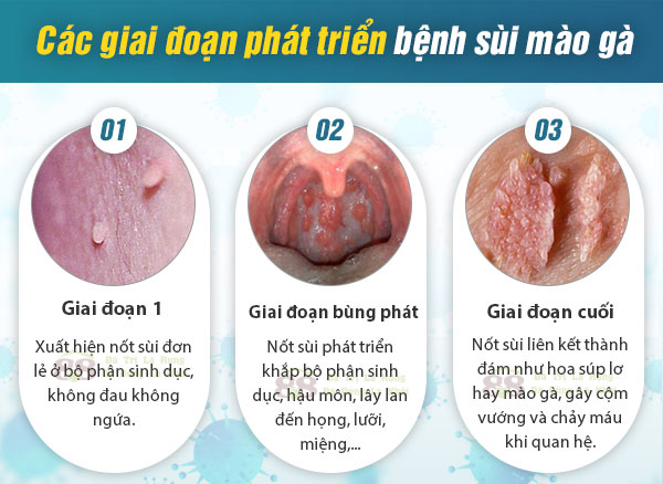 sùi mào gà giai đoạn đầu