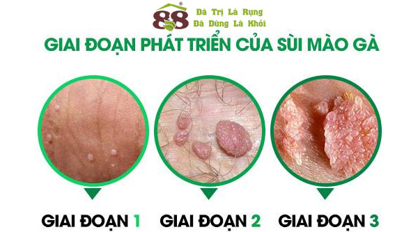 sùi mào gà nhẹ